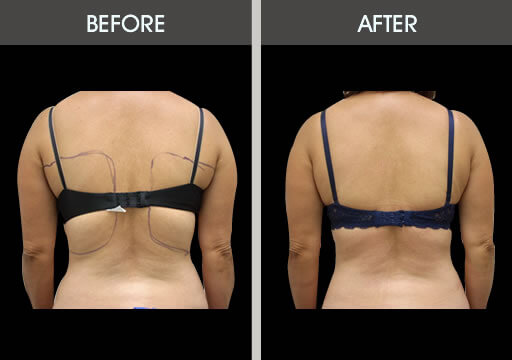 Back and bra line Liposuction (Liposculpture) at PASCAL, KCCS in Gangnam, Seoul