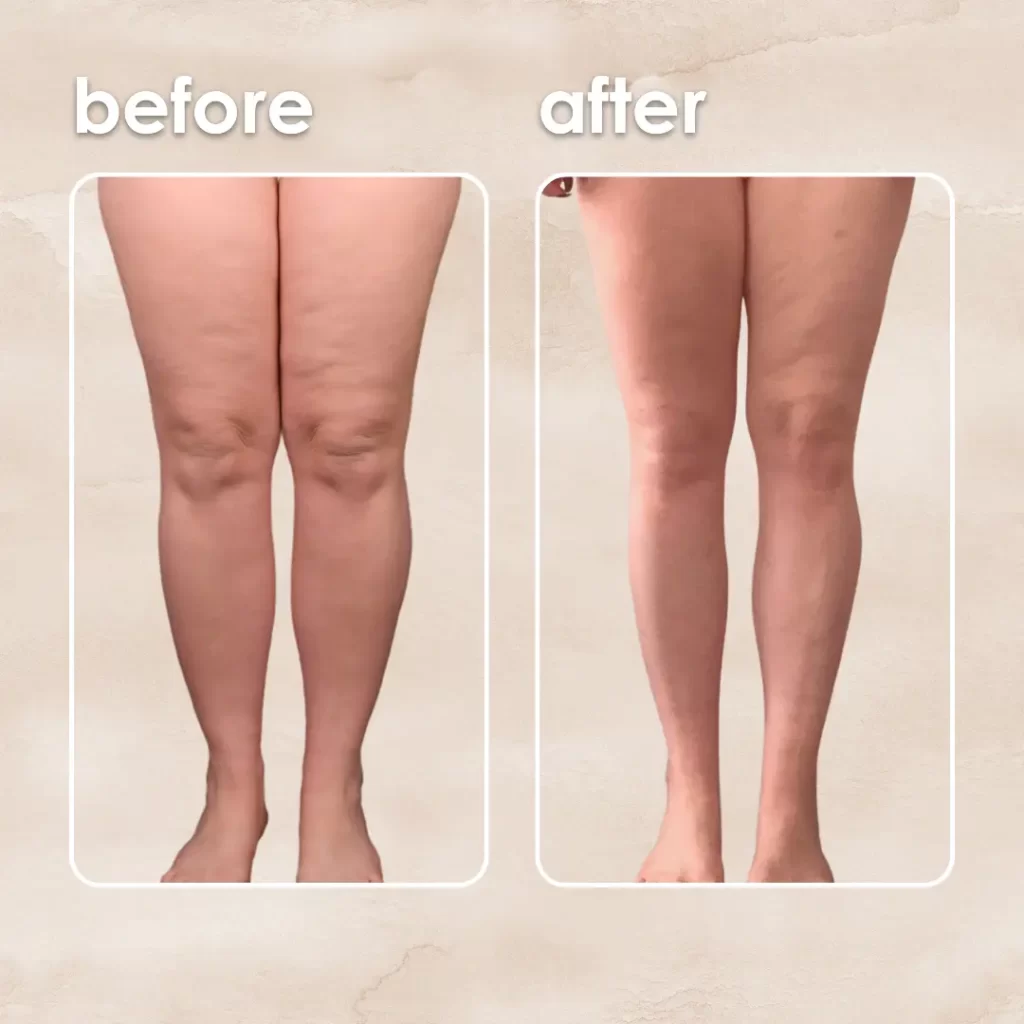 Calves and ankles  Liposuction (Liposculpture) at PASCAL, KCCS in Gangnam, Seoul