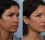 Facelifts (FLTs), medically known as rhytidectomy, is a surgical procedure designed to reduce visible signs of aging in the face and neck. It works by tightening underlying facial muscles, removing excess skin, and repositioning tissues to restore a youthful and rejuvenated appearance.