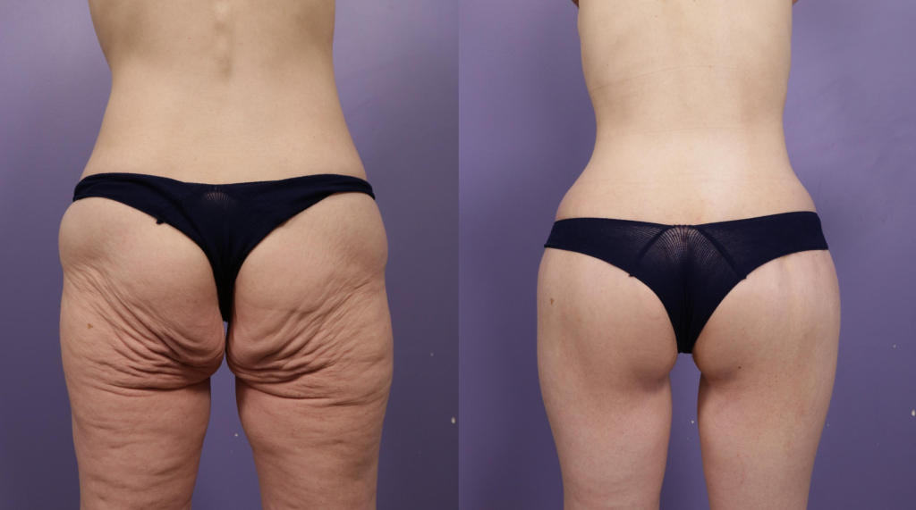 Thigh Lift (Thighplasty) at PASCAL, KCCS in Gangnam, Seoul