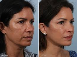 Facelifts (FLTs), medically known as rhytidectomy, is a surgical procedure designed to reduce visible signs of aging in the face and neck. It works by tightening underlying facial muscles, removing excess skin, and repositioning tissues to restore a youthful and rejuvenated appearance.