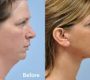 A neck lift, also known as lower rhytidectomy, is a cosmetic surgical procedure designed to improve visible signs of aging in the neck area, including excess skin, fat, and muscle laxity.