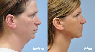 A neck lift, also known as lower rhytidectomy, is a cosmetic surgical procedure designed to improve visible signs of aging in the neck area, including excess skin, fat, and muscle laxity.