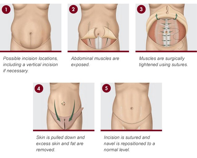 Tummy Tuck (Abdominoplasty) at PASCAL, KCCS in Gangnam, Seoul