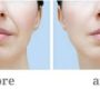 Nasolabial folds, commonly known as "smile lines" or "laugh lines," are natural facial features characterized by creases or folds of skin that extend bilaterally from the sides of the nose to the corners of the mouth.