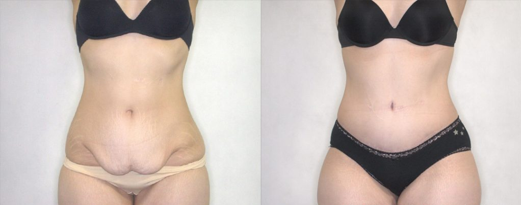 Full Abdominoplasty at PASCAL, KCCS in Gangnam, Seoul