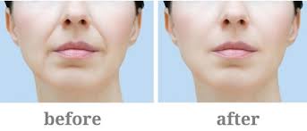 Nasolabial folds, commonly known as "smile lines" or "laugh lines," are natural facial features characterized by creases or folds of skin that extend bilaterally from the sides of the nose to the corners of the mouth.