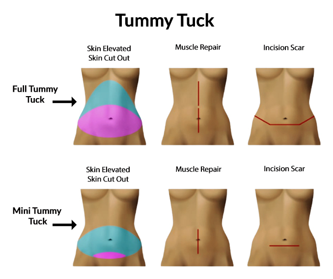 Mini Tummy Tuck at PASCAL, KCCS in Gangnam, Seoul