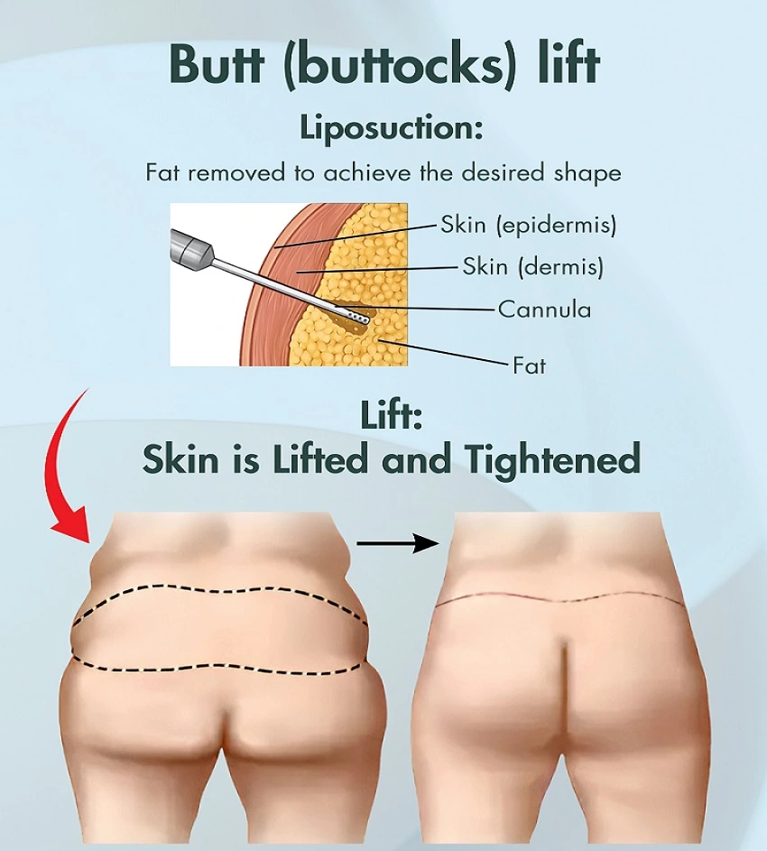 Buttock Lift at PASCAL, KCCS in Gangnam, Seoul