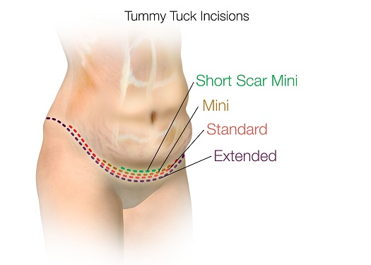 Extended Tummy Tuck at PASCAL, KCCS in Gangnam, Seoul