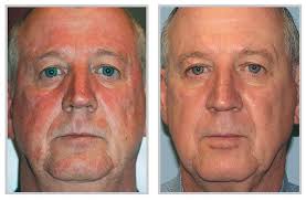 Photoaging refers to the premature aging of the skin primarily caused by repeated exposure to ultraviolet (UV) radiation from the sun and artificial sources such as tanning beds