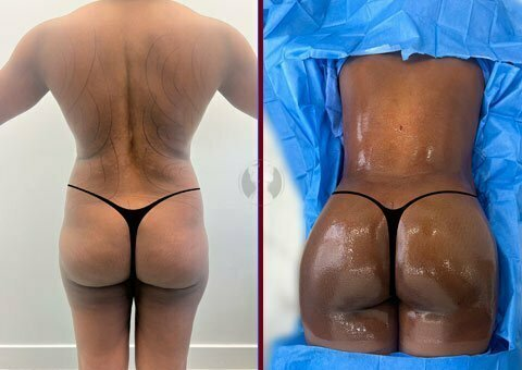 Autologous Fat Grafting (Brazilian Butt Lift – BBL) at PASCAL, KCCS in Gangnam, Seoul