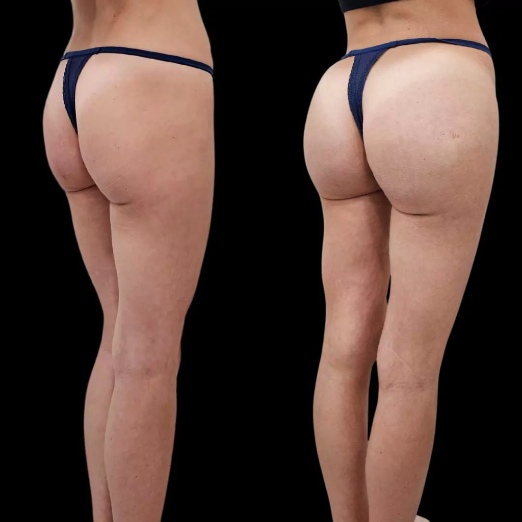Buttock Augmentation and Lift at PASCAL, KCCS in Gangnam, Seoul