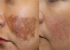 Pigmentation (PMT) refers to the coloring of the skin caused primarily by the presence of melanin, a natural pigment produced by melanocytes in the epidermis