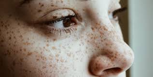 What are Freckles? Freckles, also known as ephelides, are small, flat, brownish or reddish spots typically appearing on sun-exposed areas such as the face, shoulders, and arms.