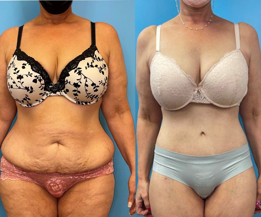 Body Lift (Lower or Full Body Lift) at PASCAL, KCCS in Gangnam, Seoul