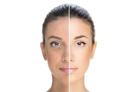 Skin-lightening agents are topical compounds used to reduce hyperpigmentation by inhibiting melanin production or promoting skin cell renewal.