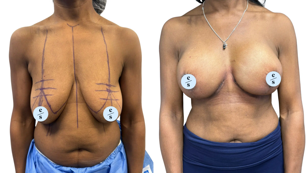 Breast Lift (Mastopexy) at PASCAL, KCCS in Gangnam, Seoul