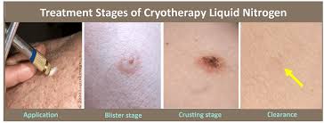 Cryotherapy (also known as cryosurgery) is a medical treatment that uses extreme cold, typically liquid nitrogen, to destroy abnormal or diseased skin tissue. It is a minimally invasive, efficient, and widely used dermatologic procedure often performed on an outpatient basis.