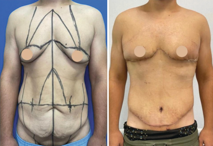 Upper Body Lift at PASCAL, KCCS in Gangnam, Seoul