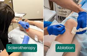 Sclerotherapy is a minimally invasive medical procedure used to treat varicose veins, spider veins, and other abnormal blood vessels. It involves injecting a special sclerosing solution directly into the affected veins, causing them to scar, collapse, and eventually fade from view.