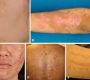 Post-inflammatory hyperpigmentation (PIH) is a common skin condition characterized by darkened patches that appear after skin inflammation or injury.