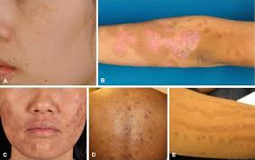 Post-inflammatory hyperpigmentation (PIH) is a common skin condition characterized by darkened patches that appear after skin inflammation or injury.