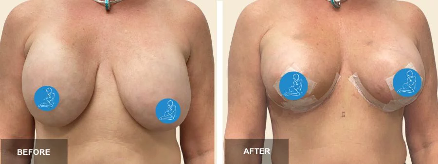 Breast Augmentation or Reduction at PASCAL, KCCS in Gangnam, Seoul