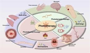 Phototherapy, or light therapy, is a medical treatment involving controlled exposure of the skin to ultraviolet (UV) light to manage various inflammatory and pigmentary skin disorders.