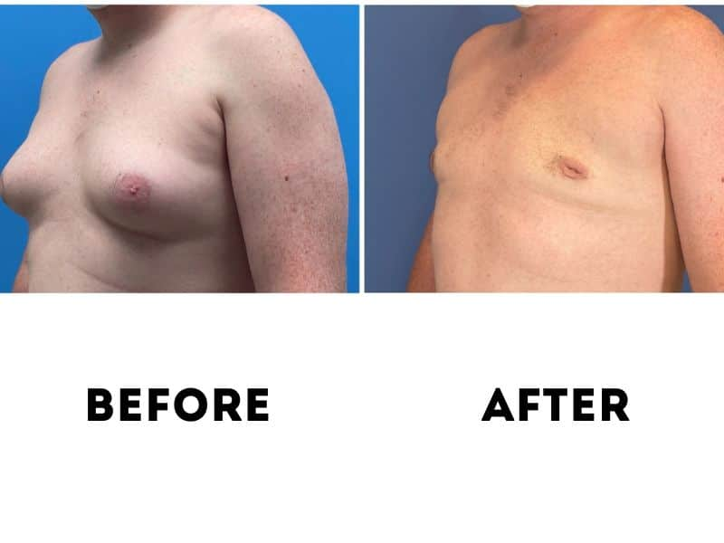 Gynecomastia Surgery (male chest reduction) at PASCAL, KCCS in Gangnam, Seoul
