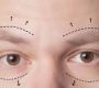 Sagging brows, medically known as brow ptosis, refer to the downward displacement of one or both eyebrows.