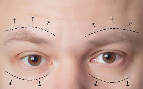 Sagging brows, medically known as brow ptosis, refer to the downward displacement of one or both eyebrows.