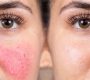 Rosacea (RSC) is a chronic inflammatory skin condition characterized by facial redness, flushing, visible blood vessels, and sometimes acneform bumps.