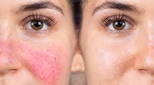 Rosacea (RSC) is a chronic inflammatory skin condition characterized by facial redness, flushing, visible blood vessels, and sometimes acneform bumps.