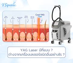 The neodymium-doped yttrium aluminum garnet (Nd:YAG) laser is a wavelength-specific laser (1064 nm) commonly used in dermatology for treating vascular and pigmented skin lesions.