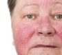 Redness at the facial area is a common symptom caused by a variety of skin conditions and underlying factors. It generally results from dilation of blood vessels (erythema) and can cause discomfort, irritation, and cosmetic concerns.