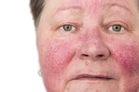 Redness at the facial area is a common symptom caused by a variety of skin conditions and underlying factors. It generally results from dilation of blood vessels (erythema) and can cause discomfort, irritation, and cosmetic concerns.