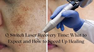 Q-switched lasers generate high-intensity pulses of light with extremely short duration (nanoseconds).