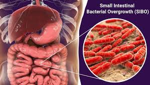 Small Intestinal Bacterial Overgrowth (SIBO) is a condition where there is an abnormal increase in the number and/or type of bacteria in the small intestine.
