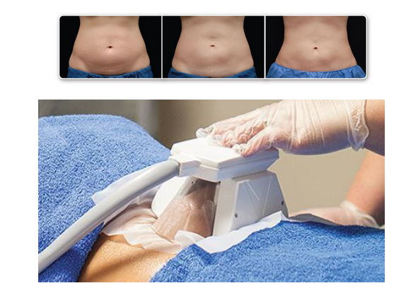 Cryolipolysis (Fat Freezing) at PASCAL, KCCS in Gangnam, Seoul