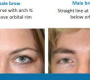 Brow furrow refers to the vertical or horizontal lines that form between or above the eyebrows, commonly known as frown lines or "11 lines." These creases develop due to repeated muscle contractions and natural aging processes, creating an appearance of worry, anger, or tiredness.
