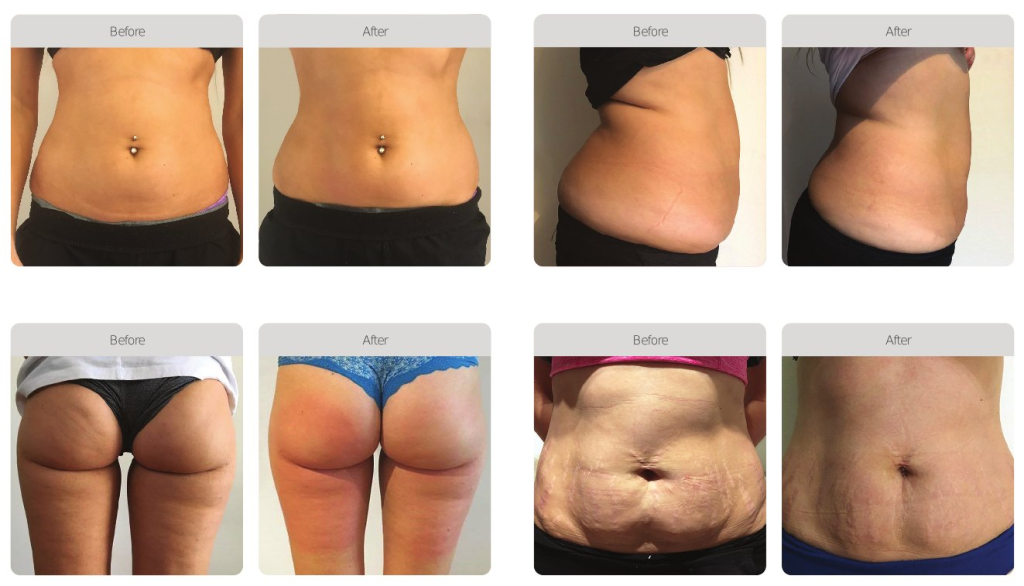 Ultrasound Cavitation at PASCAL, KCCS in Gangnam, Seoul