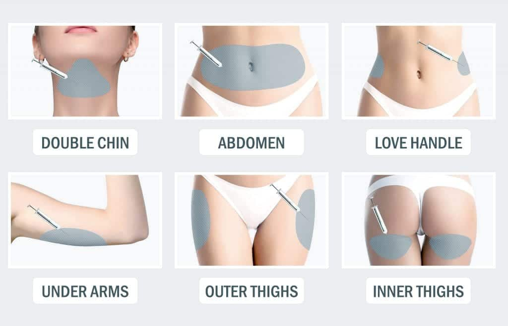 Injectable Lipolysis (fat-dissolving injections) at PASCAL, KCCS in Gangnam, Seoul