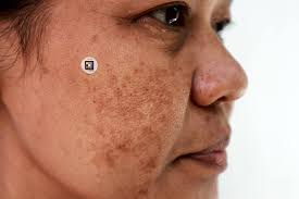 Solar lentigines, commonly known as age spots or sun spots, are flat, brown or dark patches on the skin that develop primarily due to chronic sun exposure and are a hallmark of photoaging. They are benign but cosmetically concerning for many individuals.
