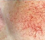 Telangiectasias (Spider Veins), are small, dilated blood vessels located near the surface of the skin or mucous membranes.