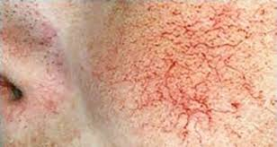 Telangiectasias (Spider Veins), are small, dilated blood vessels located near the surface of the skin or mucous membranes.