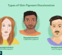 Pigmentation disorders refer to conditions where there is an abnormality in skin color due to changes in melanin production or distribution.