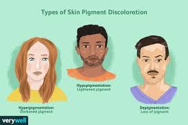 Pigmentation disorders refer to conditions where there is an abnormality in skin color due to changes in melanin production or distribution.