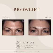 A brow lift, also known as a forehead lift, is a surgical cosmetic procedure that elevates and repositions the brow and forehead tissues to reduce sagging, wrinkles, and lines in the upper face.