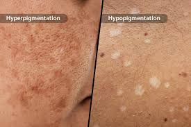Hypopigmentation (HPP) is a reduction or loss of skin color due to decreased melanin production or loss of melanocytes in certain areas of the skin.